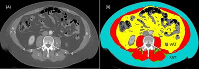 Obesity, Sarcopenia, and Outcomes in Non-Small Cell Lung Cancer Patients Treated With Immune Checkpoint Inhibitors and Tyrosine Kinase Inhibitors